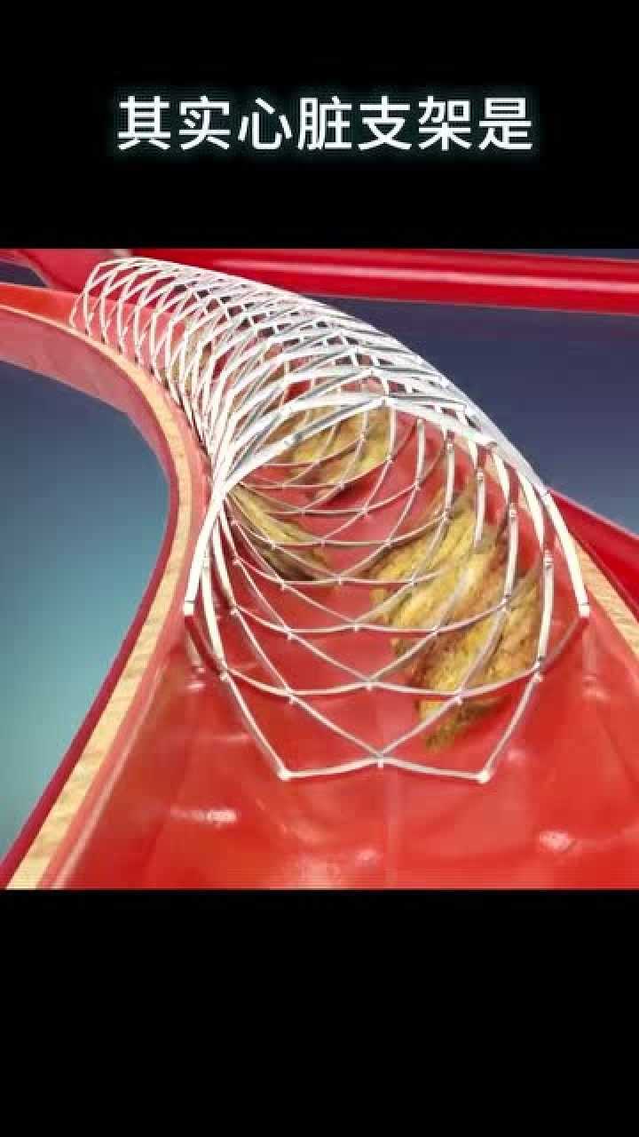 心脏支架手机_心脏支架手机有辐射吗_心脏支架手机游戏