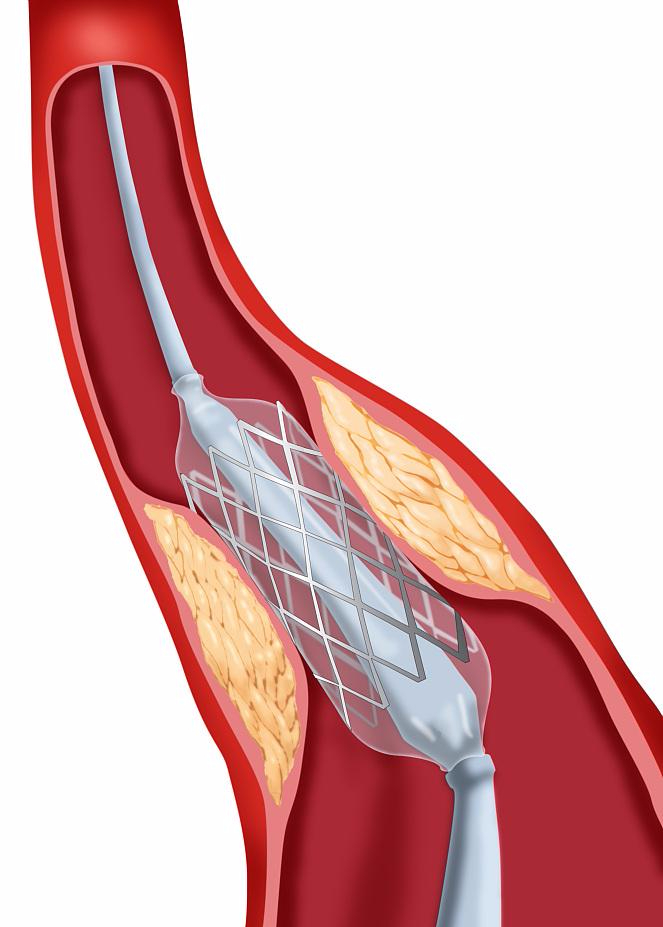 心脏支架手机_心脏支架手机有辐射吗_心脏支架手机游戏