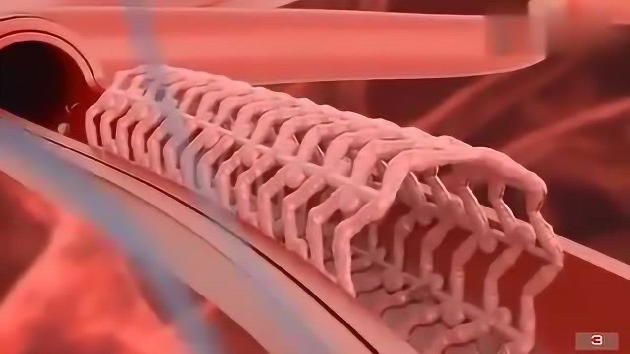 心脏支架手机_心脏支架手机有辐射吗_心脏支架手机游戏